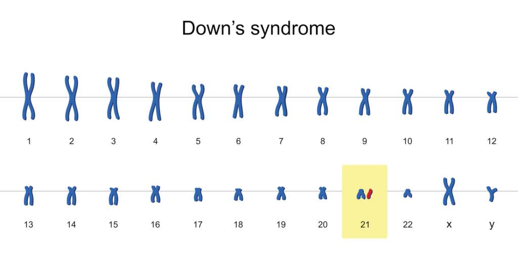 Enfants-de-dieu.  Display of human genes with a trisomy of Chromosome 21.